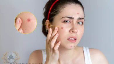 چرا صورتم جوش سر سفید میزنه؟ + 7 دلیل مهم