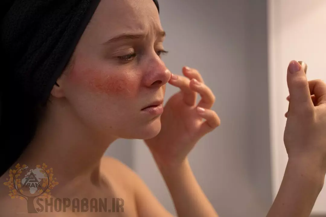 دلایل ایجاد جوش سرسیاه چیست + درمان و رفع جای جوش سرسیاه 100% تضمینی 22