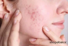 از بین بردن جای جوش با روش‌های خانگی و پزشکی