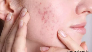 از بین بردن جای جوش با روش‌های خانگی و پزشکی