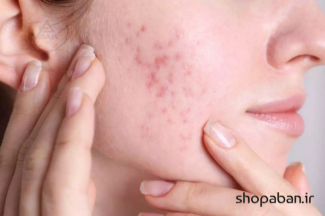 از بین بردن جای جوش با روش‌های خانگی و پزشکی