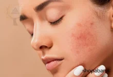 رفع لک صورت با روش‌های خانگی و فوری