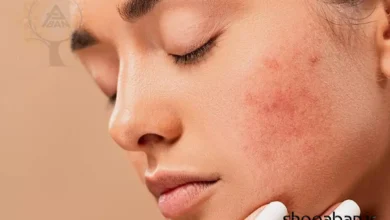 رفع لک صورت با روش‌های خانگی و فوری