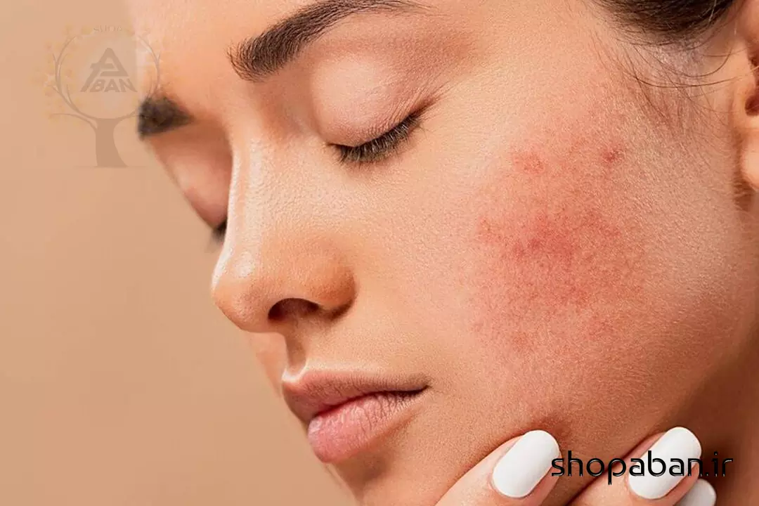 رفع لک صورت با روش‌های خانگی و فوری