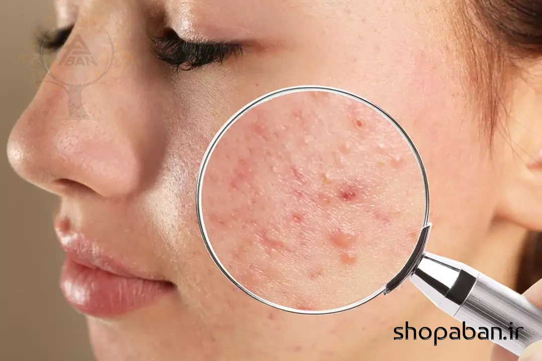 میکرونیدلینگ برای رفع جای جوش