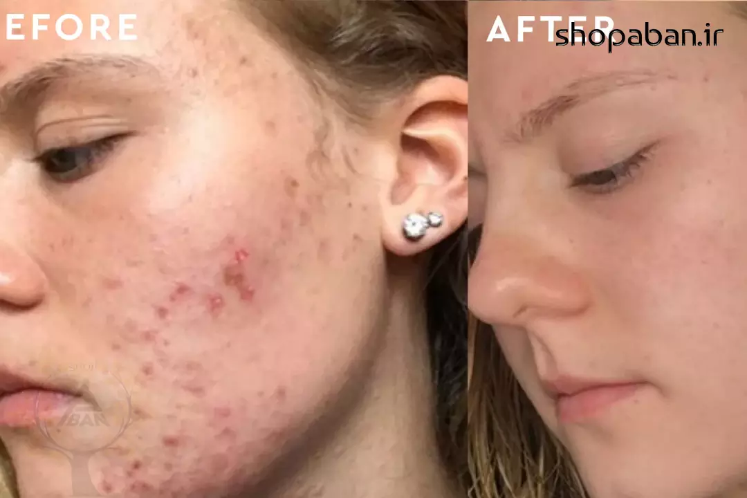 قبل و بعد ترفند نابودی جوش های صورت