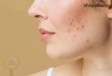 ترفندهای کره‌ای برای نابودی سریع جوش صورت