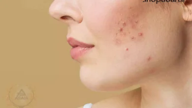 ترفندهای کره‌ای برای نابودی سریع جوش صورت