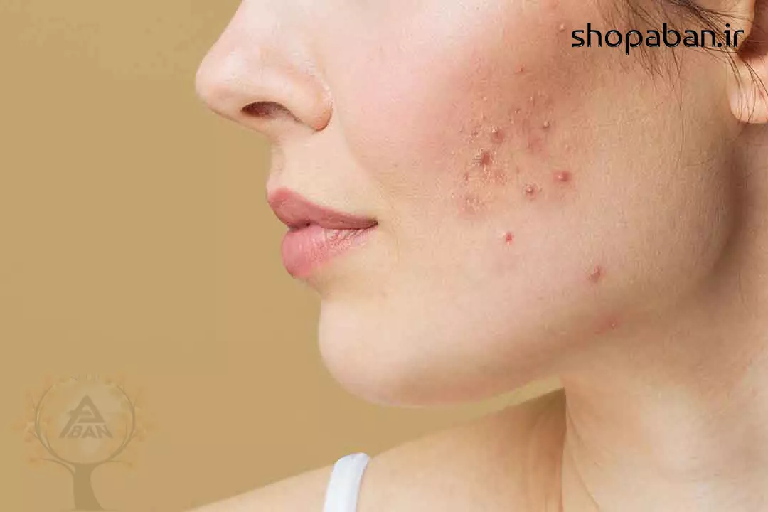 نابودی سریع جوش صورت در 60 ثانیه با ترفندهای دختران کره ای 1 ترفندهای کرهای برای نابودی سریع جوش صورت