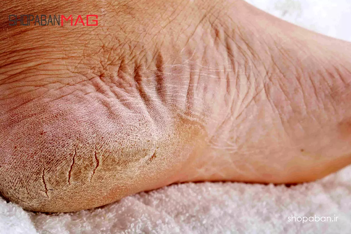 ترک های پوستی زیر جوراب سیلیکونی به دلیل عوارض آن